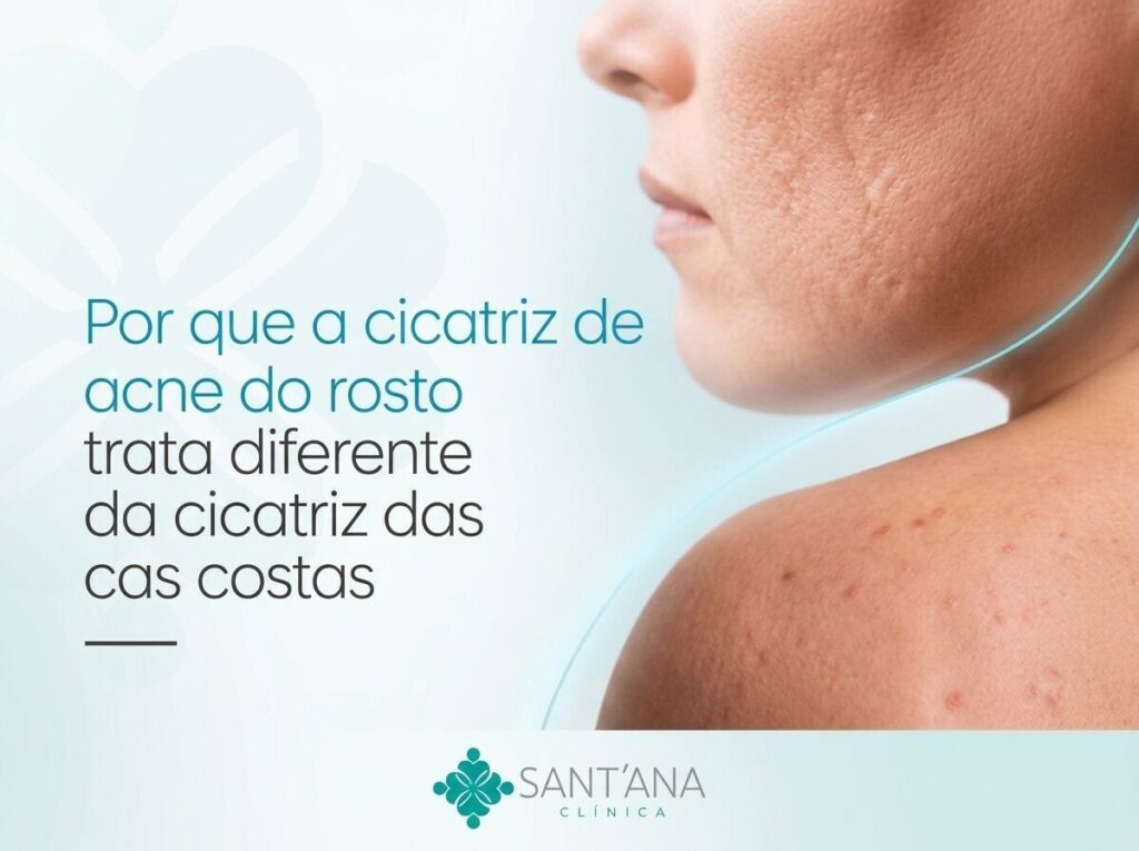 Cicatriz e Acne
